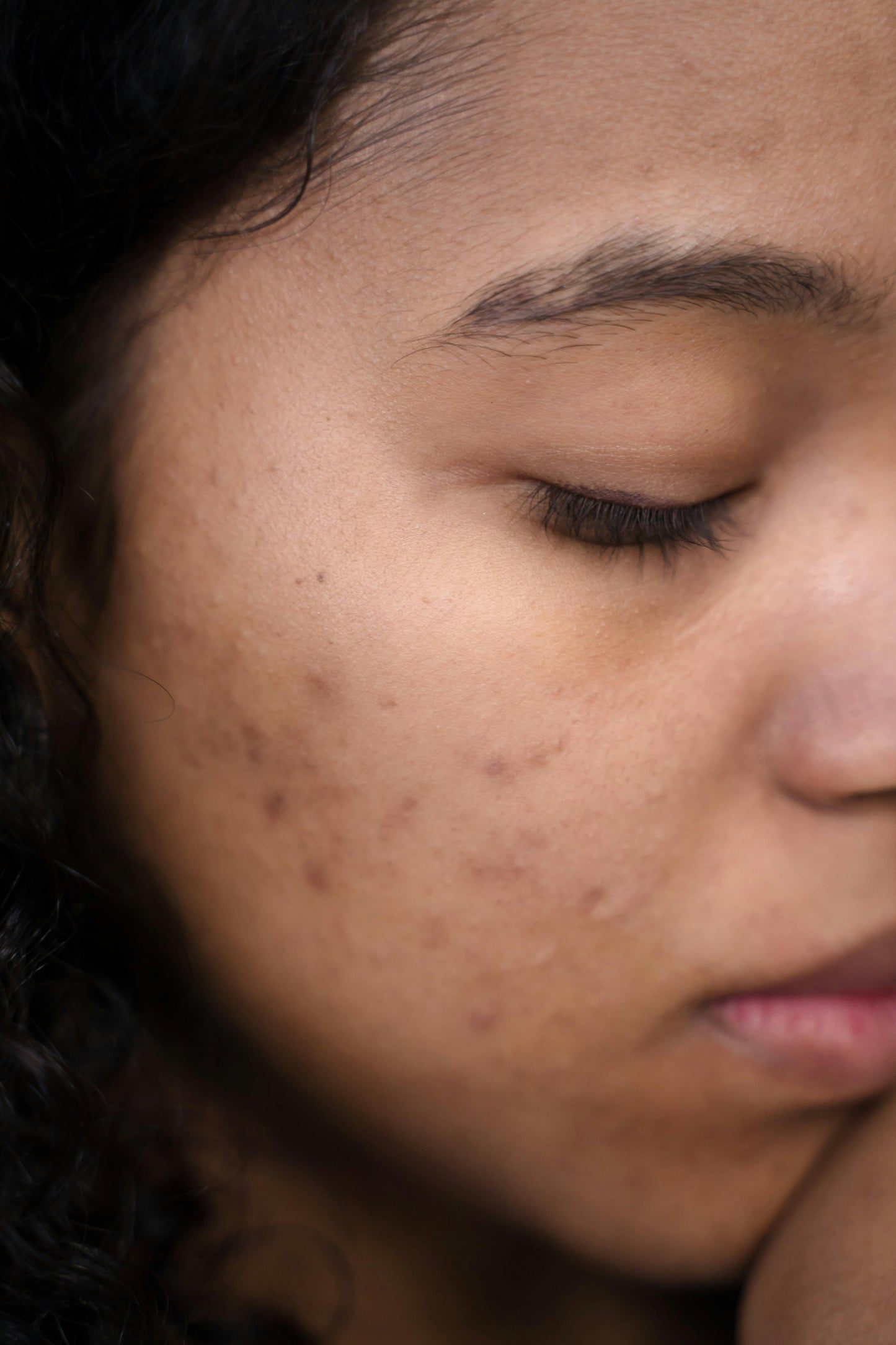 Sea Moss: Your Natural Weapon Against Acne and Scarring